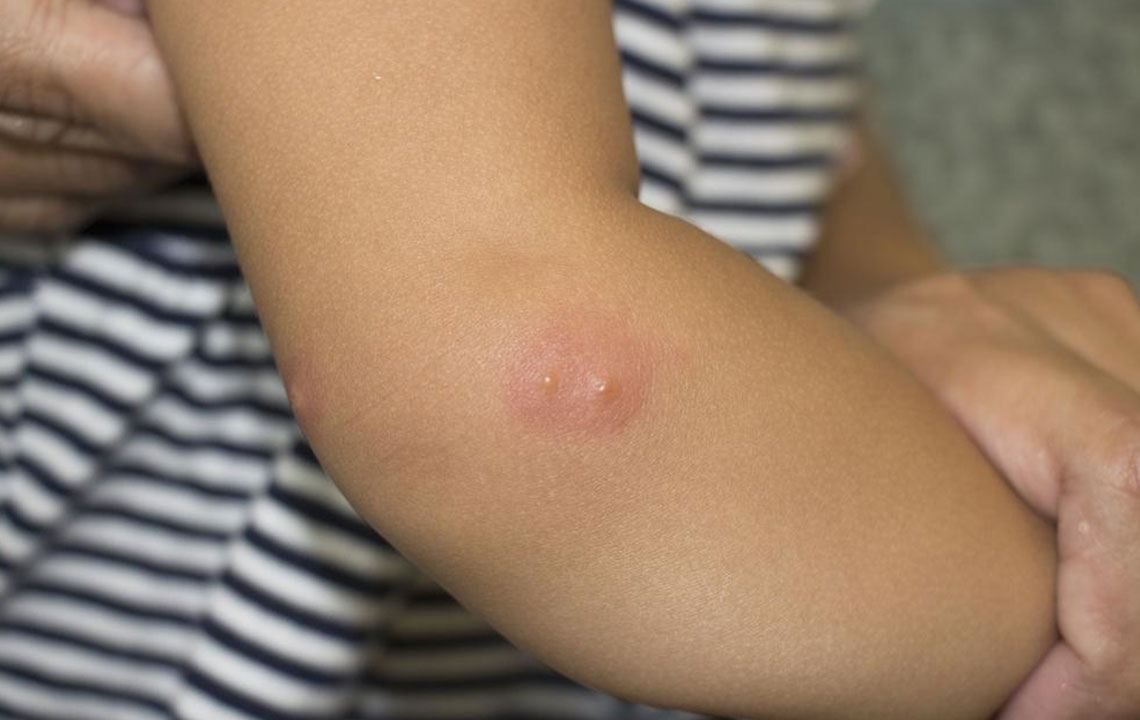 Here’s What You Need to Know about Shingles and Its Symptoms